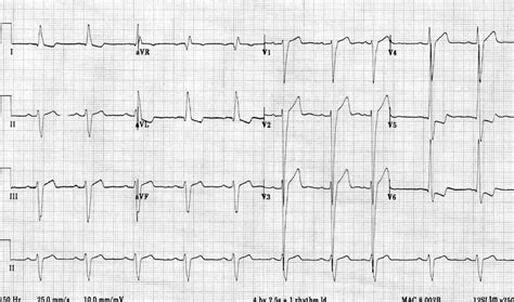 lv ecg|ecg showing lvh.